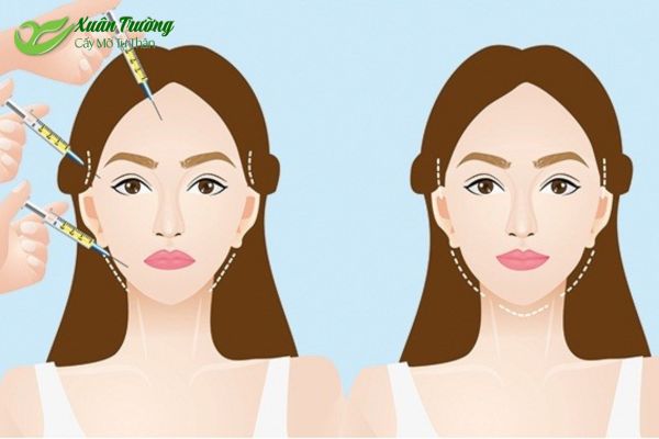 Tiến hành hút, xử lý và cấy mỡ bằng công nghệ hiện đại
