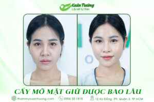 Cấy mỡ mặt giữ được bao lâu