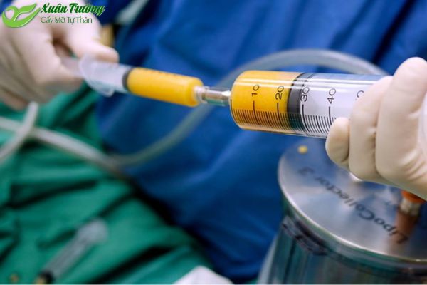 Bác sĩ thực hiện quy trình cấy mỡ tự thân an toàn