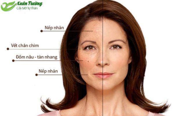 Khách hàng sở hữu gương mặt đầy đặn sau cấy mỡ