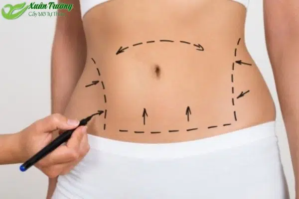 Bác sĩ thực hiện lấy mỡ từ vùng bụng hoặc đùi