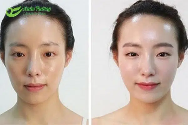 Làn da căng mịn, trẻ trung sau khi cấy mỡ