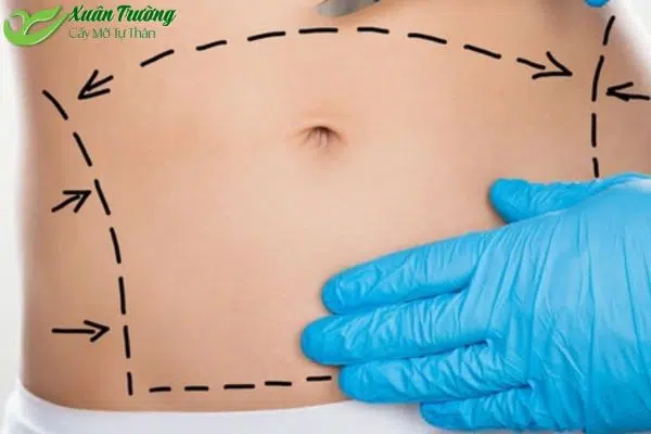 Vị trí lấy mỡ trên cơ thể – liệu cấy mỡ có để lại sẹo không?