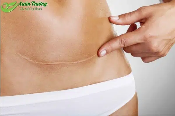 Cấy mỡ có để lại sẹo không nếu chăm sóc đúng cách