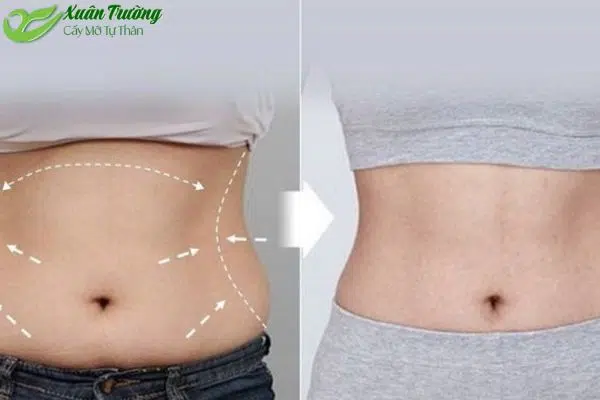 Cấy mỡ có để lại sẹo không là điều cần lưu ý.