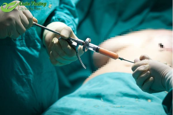 Quy trình cấy mỡ tự thân chuẩn y khoa an toàn hiệu quả