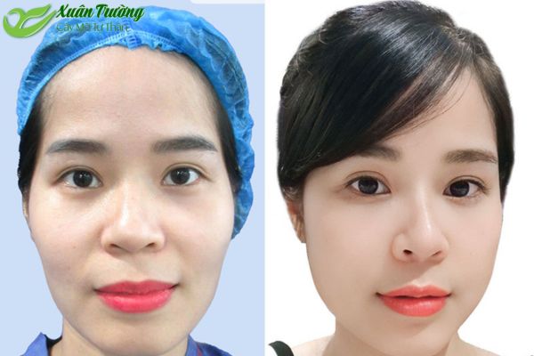 Khách hàng thực tế trước - sau cấy mỡ tự thân