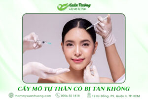 Cấy mỡ tự thân có bị tan không