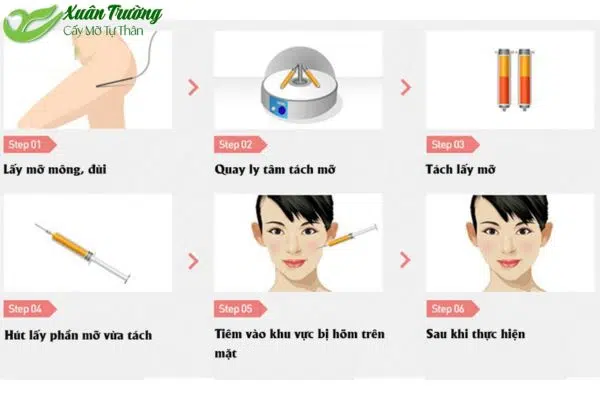 Quy trình cấy mỡ mặt được thực hiện bởi bác sĩ chuyên môn cao