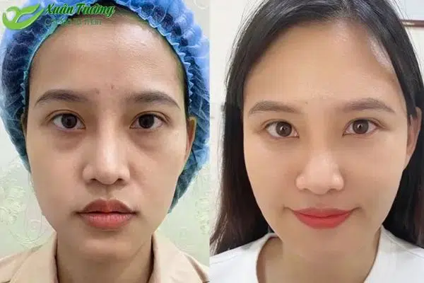 Kết quả cấy mỡ mặt mang lại khuôn mặt đầy đặn, tự nhiên