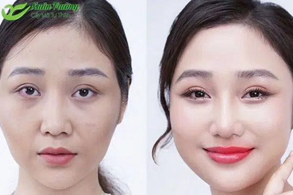 Khách hàng hồi phục nhanh nhờ chăm sóc đúng sau cấy mỡ mặt