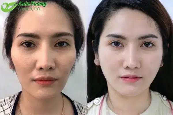 Kết quả cấy mỡ mặt sau 1 tháng thực hiện