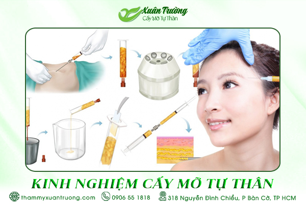 kinh nghiệm cấy mỡ tự thân