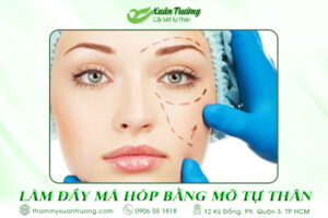 làm đầy má hóp bằng mỡ tự thân