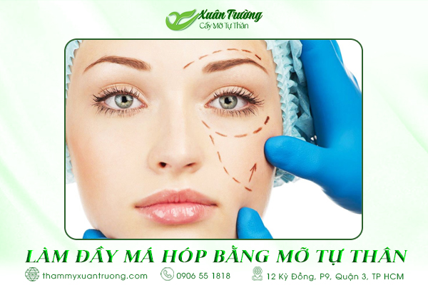 làm đầy má hóp bằng mỡ tự thân