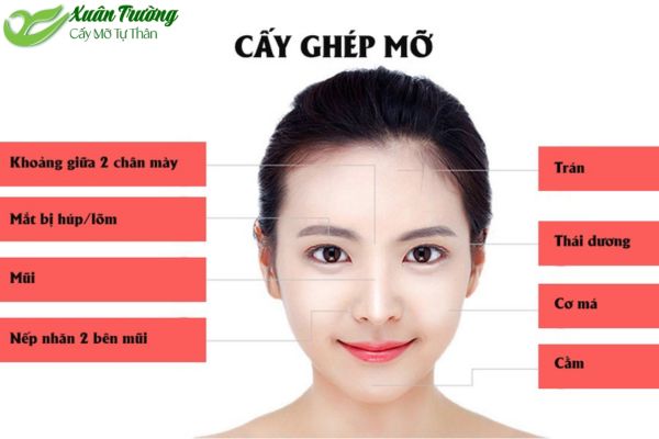Cấy Mỡ đồng hành trẻ hóa da, giữ nét đẹp tự nhiên.