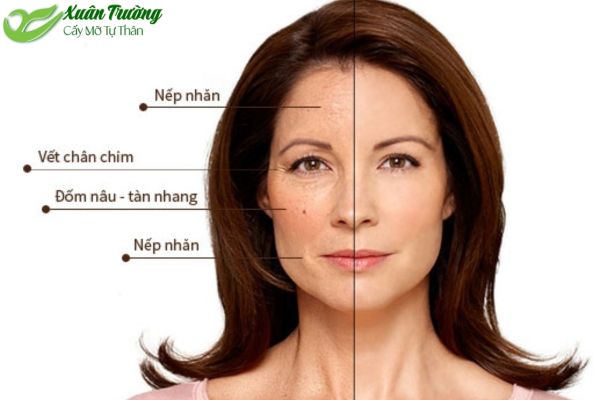 Quy trình làm đầy nếp nhăn bằng cấy mỡ tự thân
