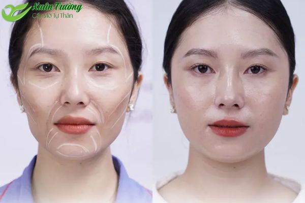 Hiệu quả sau khi cấy mỡ làm đầy rãnh nhăn sâu