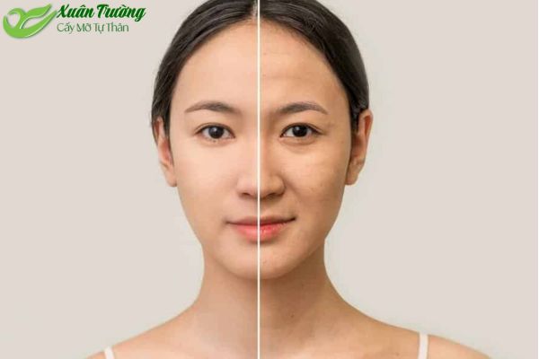 Cấy mỡ tự thân giúp làn da mịn màng, săn chắc