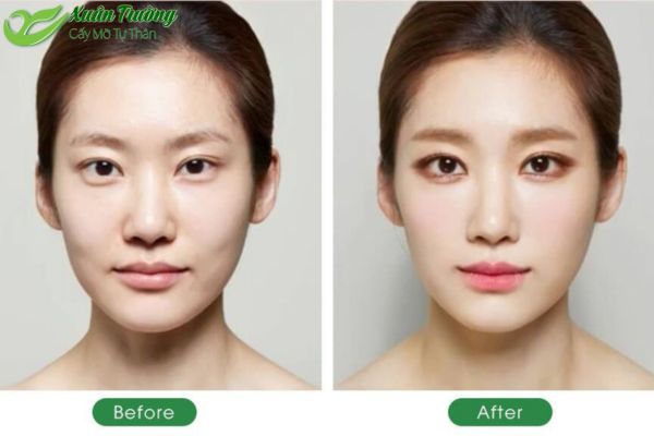 Vùng thái dương đầy đặn tự nhiên nhờ cấy mỡ tự thân an toàn