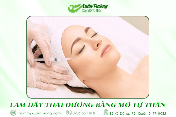 làm đầy thái dương bằng mỡ tự thân