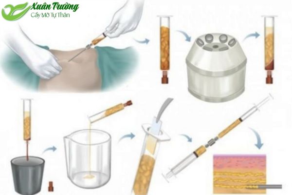 Quy trình cấy mỡ tự thân: Hút mỡ và cấy lại an toàn