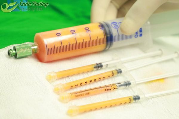 Bác sĩ đang xử lý mỡ tự thân trước khi cấy