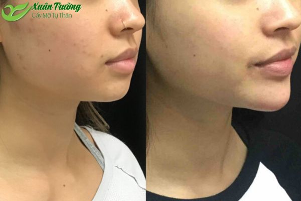 Hình ảnh trước và sau khi làm đầy bằng filler