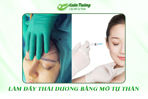 nên cấy mỡ tự thân hay tiêm filler