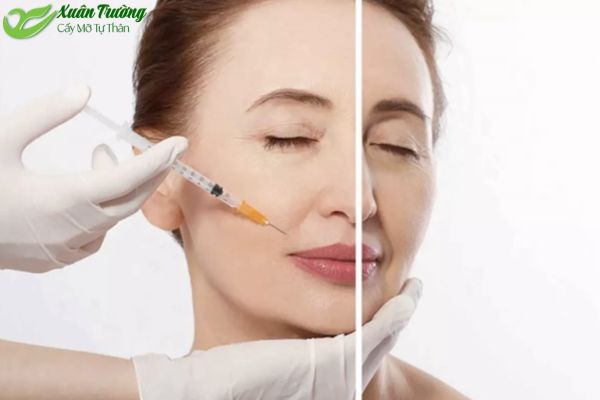 Ứng dụng mỡ tự thân – giải pháp an toàn, tự nhiên