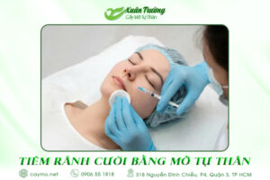 tiêm rãnh cười bằng mỡ tự thân