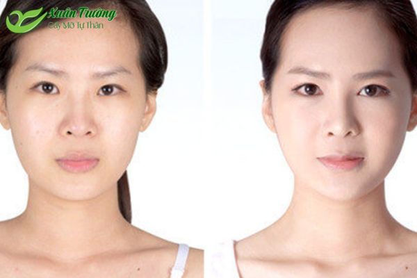 Trước và sau khi thực hiện cấy mỡ tự thân