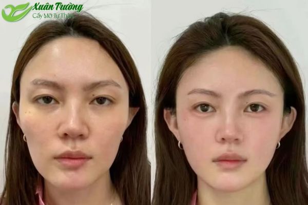Cấy mỡ tự thân giúp cải thiện đường nét, mang lại vẻ đẹp tự nhiên.