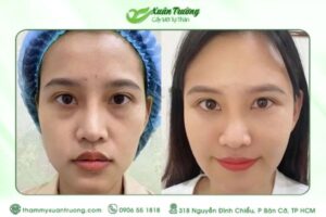 Cấy mỡ bao lâu thì ổn định