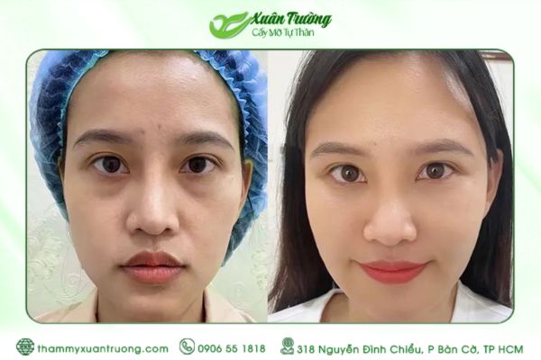 Cấy mỡ bao lâu thì ổn định