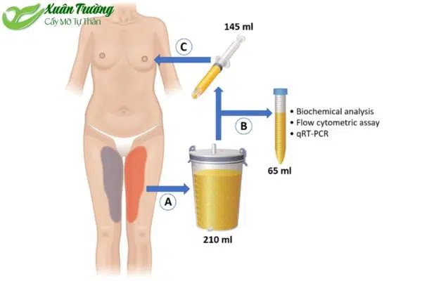 Quy trình cấy mỡ tự thân giúp cải thiện vóc dáng tự nhiên