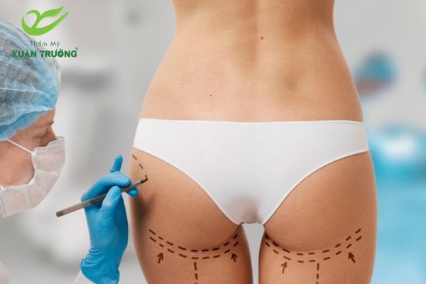 Mỡ tự thân được lấy từ vùng bụng, đùi hoặc eo của chính bạn
