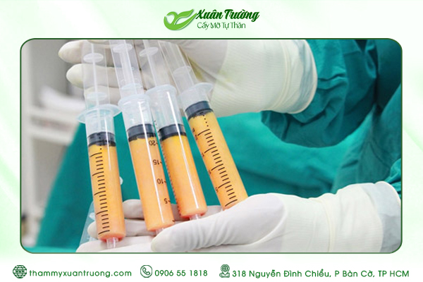 Có Nên Cấy Mỡ Tự Thân Không