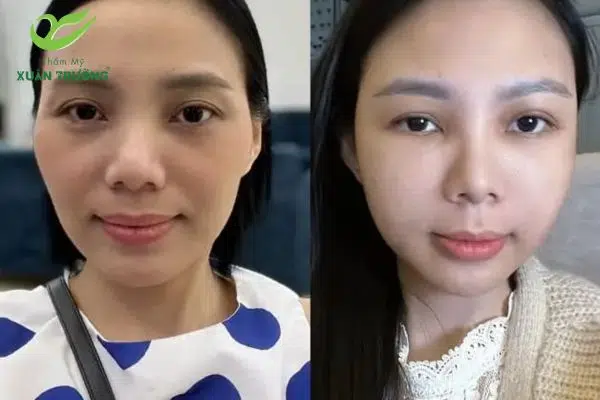 Kỹ thuật cấy mỡ chuẩn giúp tăng tỷ lệ sống tế bào mỡ