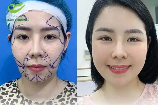 Lựa chọn mỡ chất lượng quyết định hiệu quả thẩm mỹ sau cấy