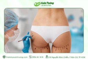 Cấy mỡ mông vùng khuyết giúp vòng mông tự nhiên hơn