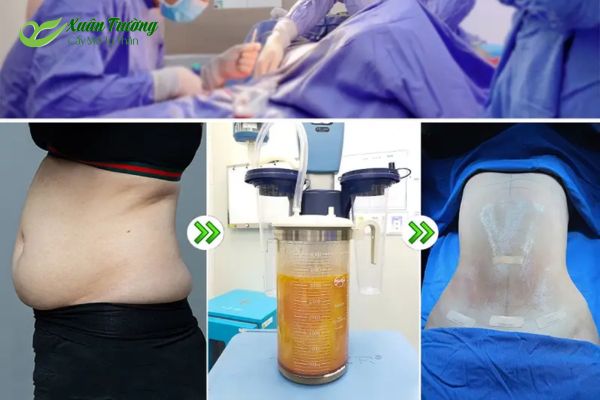 Thiết bị hút mỡ bụng chuyên dụng