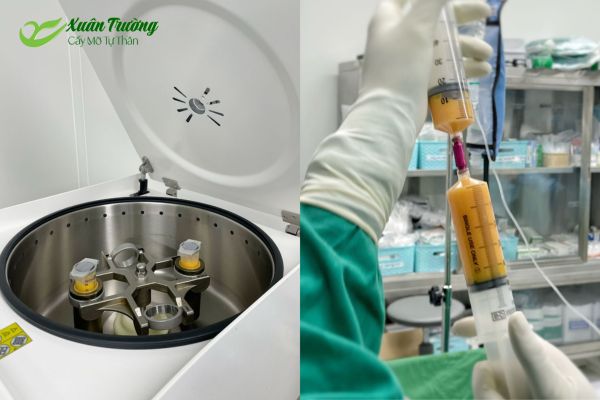 Quy trình hút mỡ bụng và ly tâm tinh lọc mỡ trước khi cấy lên mặt