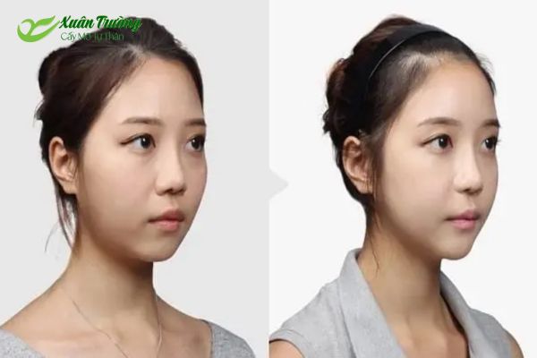 Khách hàng trước và sau 3 tháng cấy mỡ mặt từ mỡ bụng