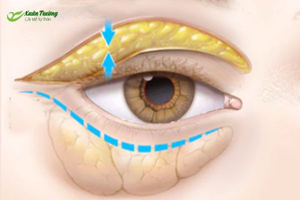 Vùng mí dưới bị trũng sâu cần cấy mỡ để cải thiện