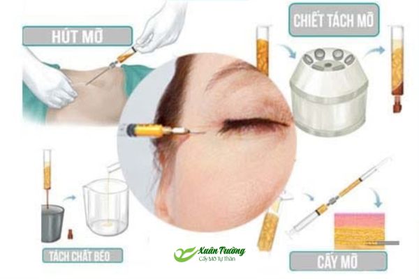 Quy trình cấy mỡ mí dưới bằng mỡ tự thân an toàn
