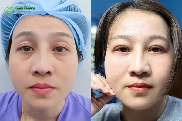 Kết quả thực tế trước – sau khi cấy mỡ mí dưới sau 2 tuần