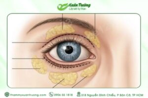 cấy mỡ mí dưới