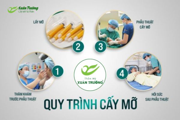 Quy trình cấy mỡ ảnh hưởng đến hiệu quả duy trì lâu dài